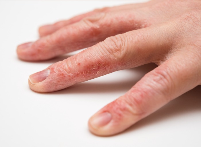 https://www.mydermatologyassociates.com/wp-content/uploads/2022/05/hand-eczema.jpg