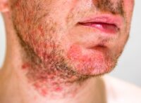 Man with dermatitis on his face
